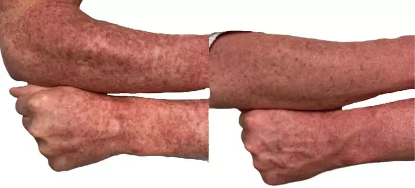 Aquafirme XS before and after results