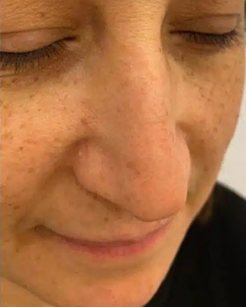 After treatment