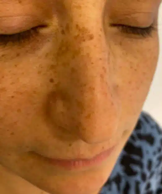 Before treatment